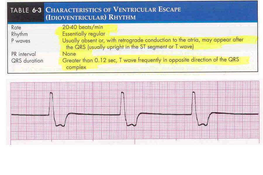 ventricular escape rhythm