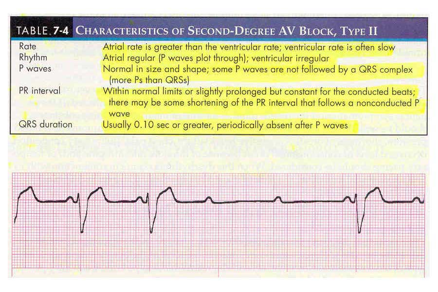 Atrioventricular Blocks